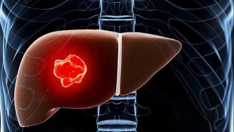 Karaciğerde görülen kolanjiyo kanserlerini tetikleyen beş etken