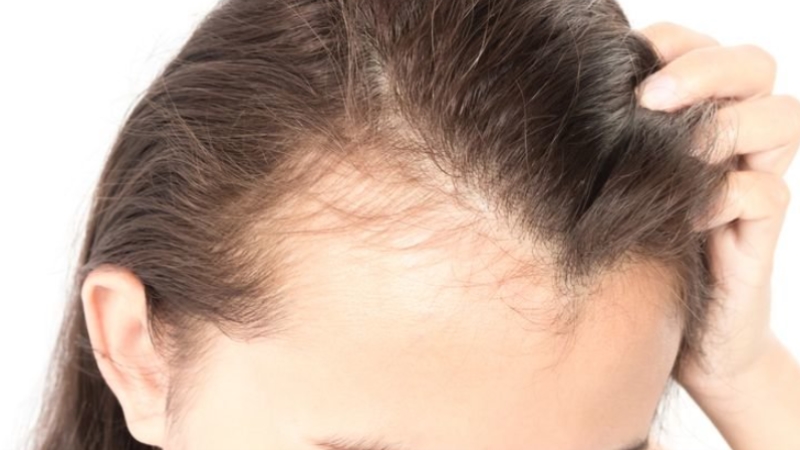 Kök hücre tedavisiyle saç dökülmesini durdurulabilir
